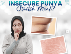 RSUD Pandega Pangandaran Edukasi Penyebab dan Mengatasi Stretch Mark